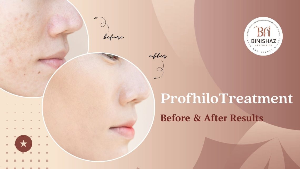 Profhilo treatment: before and after