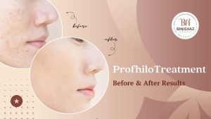 Profhilo treatment: before and after